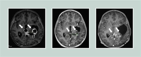 New Drug Can Help Treat Aggressive Deep Rooted Brain Tumors Sciencealert