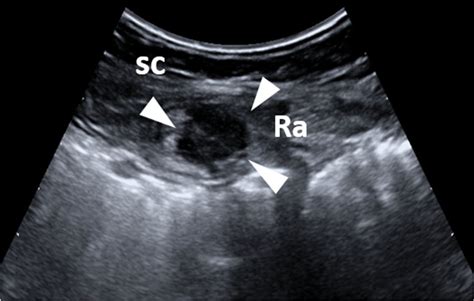 Short Axis Sonogram With A Convex Transducer Shows A Hypoechoic Download Scientific Diagram