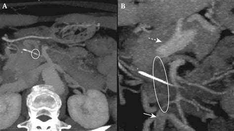 A Rare Cause Of Mesenteric Vein Thrombosis European Journal Of