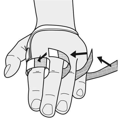 Ulnar drift splint - Orfit Industries | Hand therapy, Occupational therapy, Physical rehabilitation