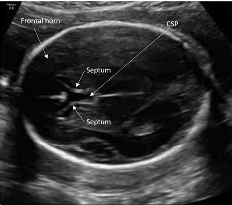 Absent Cavum Septi Pellucidi American Journal Of Obstetrics Gynecology