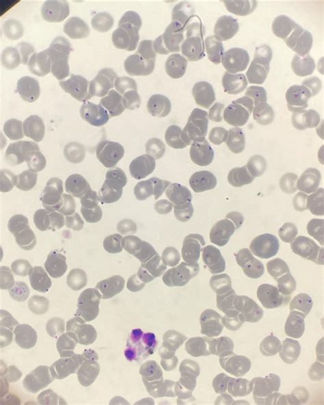 Plasmodium falciparum in a patient sample. You can kind of see a few ...