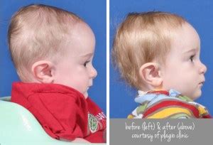 Plagiocephaly: The 411