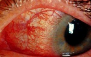 Episcleritis Plano Save Sight Empower Lives