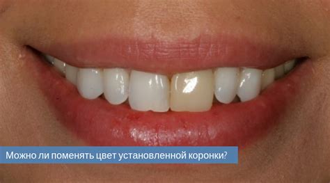 Как поменять цвет зубной коронки? | Стоматология Ас-Стом | Санкт ...