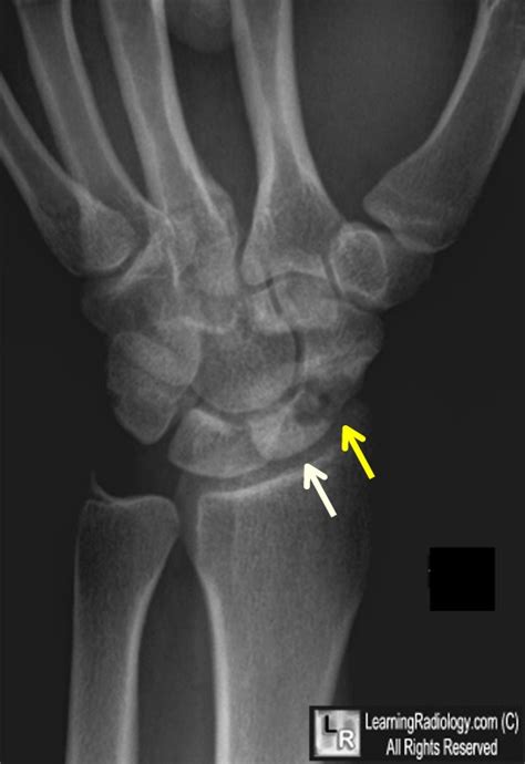 Scaphoid Fracture Avascular Necrosis