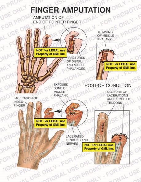 Finger Amputation U4 Generic Medical Legal Exhibits A Division Of MVI