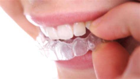 How Much Does Invisalign Treatment Cost Masri Orthodontics