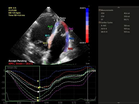 Right Ventricular Strain