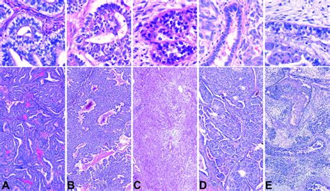 Expression And Mutation Analysis Of Egfr C Kit And Catenin In