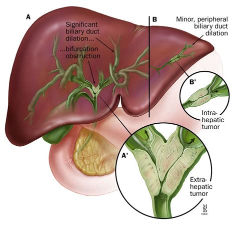 Johns Hopkins Liver Tumor Center Bile Duct Cancer Cholangiocarcinoma