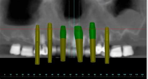 Guided Dental Implant Surgery, Surgical Stent for Dental implants