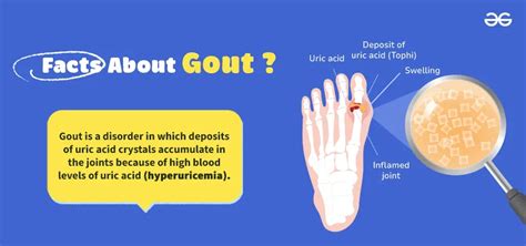 Facts About Gouts Type Of Arthritis Geeksforgeeks