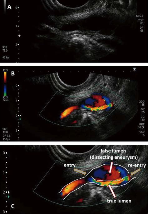 Preoperative Transoral Carotid Ultrasonography TOCU A B Mode Image