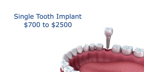 Dental Implant Cost Cost Breakdown Of Dental Implants In Canada