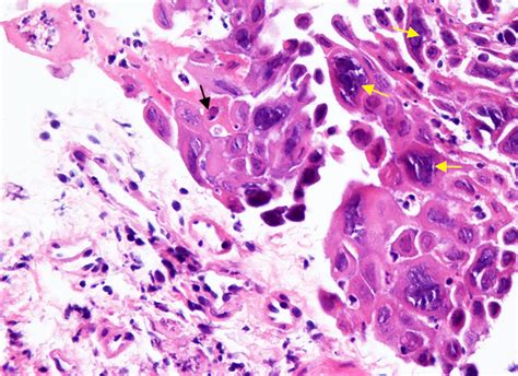 Infectious Esophagitis In The Immunosuppressed Candida And Beyond