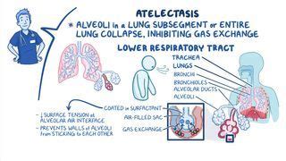 Atelectasis What Is It Causes Diagnosis And More Osmosis