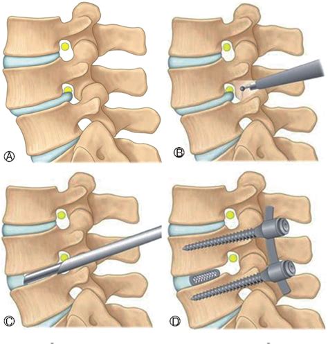 [pdf] Feasibility Of Endoscopic Transforaminal Lumbar Interbody Fusion Etlif Through The