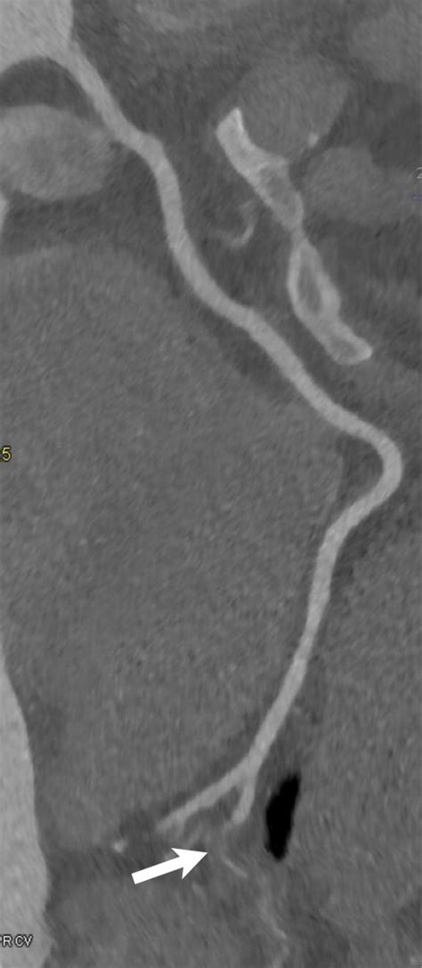 Role Of Coronary Ct Angiography In Spontaneous Coronary Artery