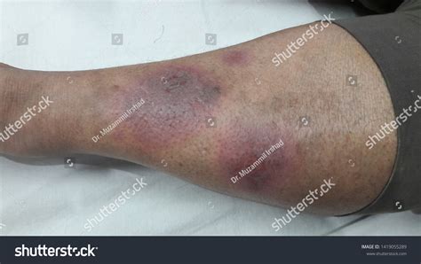 Erythema Nodosum Reddish Painful Lumps Legs Stok Fotoğrafı 1419055289