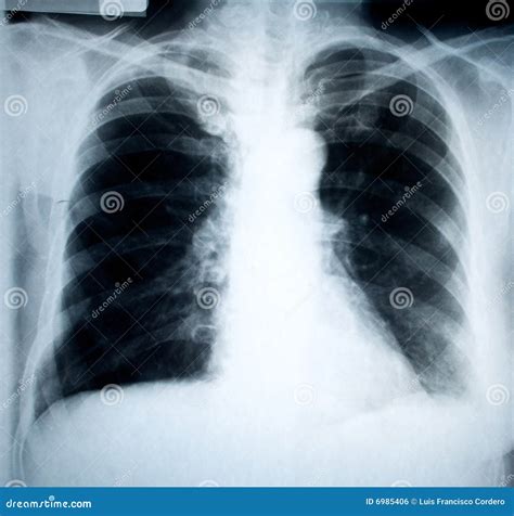 Chest Xray Stock Photo Image Of Silver Highlight Background