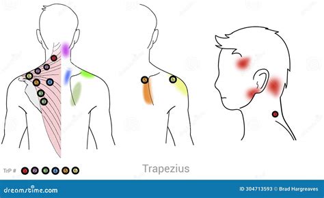 Trapezius Muscle Managing Pain Arriving From Myofascial Trigger Points