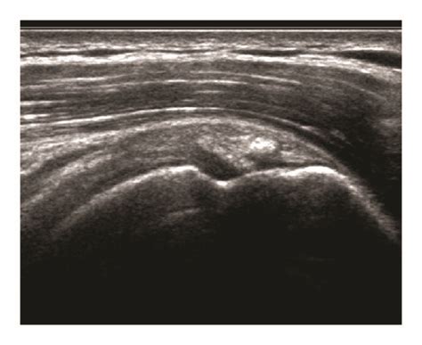 Ultrasound Appearance Of Calcific Tendinopathy A Arc Morphology