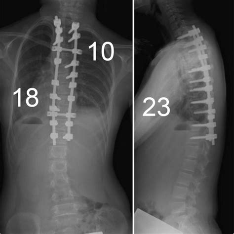 Scoliosis X Ray Before And After