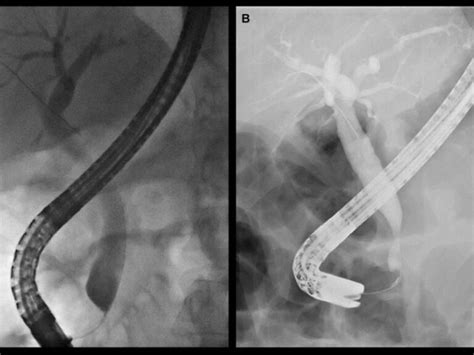 Biliary Stricture Bile Duct Cancer Surgeon In Pune Dr Manoj Dongare