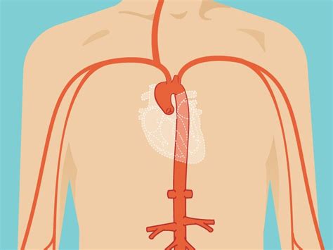 Ascending Aortic Aneurysm Repair Surgery And Size Criteria