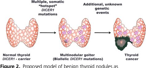 Multinodular Thyroid