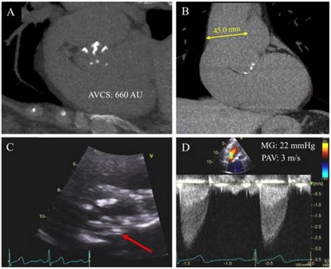 J Imaging Free Full Text Aortic Valve Calcium Score By Computed