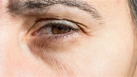 What causes bags under eyes? Unraveling the Mystery