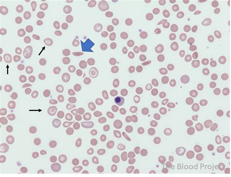 Hemoglobin Sc Disease Blood Smear