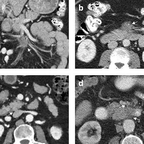 Example For Each Enhancement Pattern On Cect With The Tumor Indicated