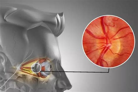 Optic Neuritis: Symptoms, Treatment, Causes | Diseases 2024