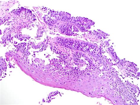 Pathology Outlines Squamous Cell Carcinoma