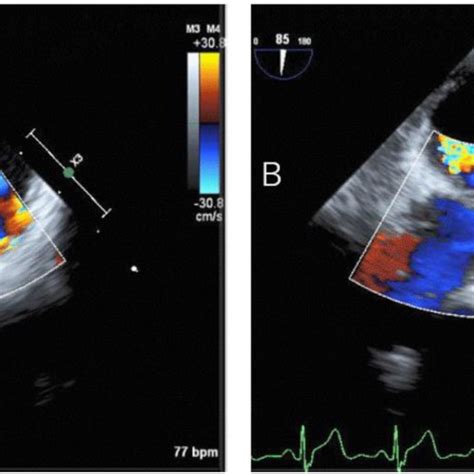 Transesophageal echocardiography (TEE). During TEE, the posture was... | Download Scientific Diagram