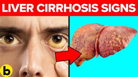 Early Signs Of Cirrhosis Of The Liver