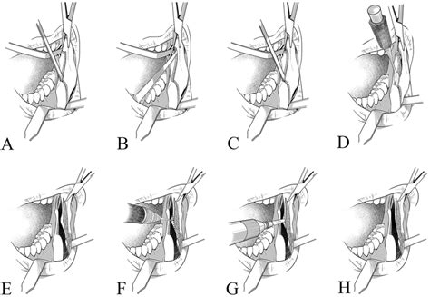 Procedure for sagittal splitting and mandibular angle ostectomy. (A) A ...