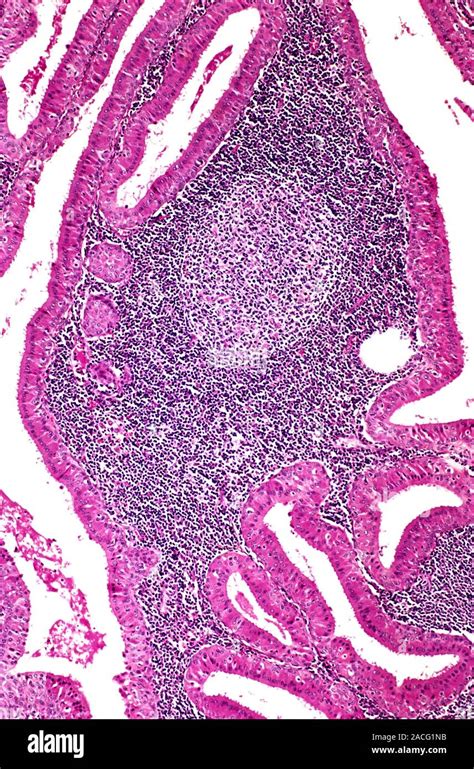 Salivary Gland Tumour Light Micrograph Of A Section Through The