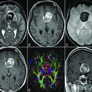 Patient 1 Pre Operative MRI Of The Brain With Axial TSE T2 WI A