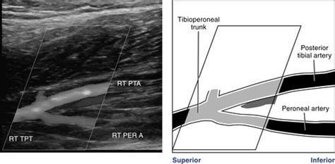 Peroneal Artery Ultrasound