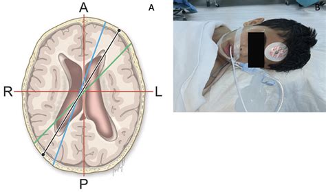 Axial depiction of the entry point and trajectory of the ventricular ...