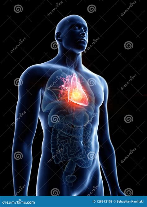 A mans heart tumor stock illustration. Illustration of cardiac - 128912158