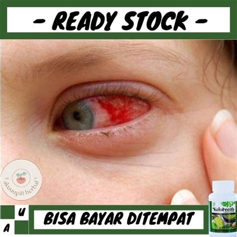 Jual Obat Mata Merah, Obat Untuk Mata Merah, Obat Infeksi Mata, Obat ...