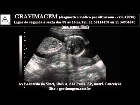 Gravimagem Ultra Som Morfol Gico D Em Gravidez Semanas