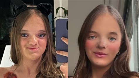 Foto Rafaella Justus antes e depois rinoplastia completa um mês neste