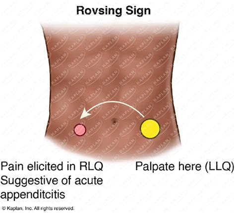 Rovsing Sign