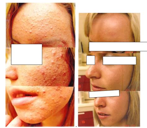 A Left Panels Showed An Acne Patient With Severe Follicular Plugging